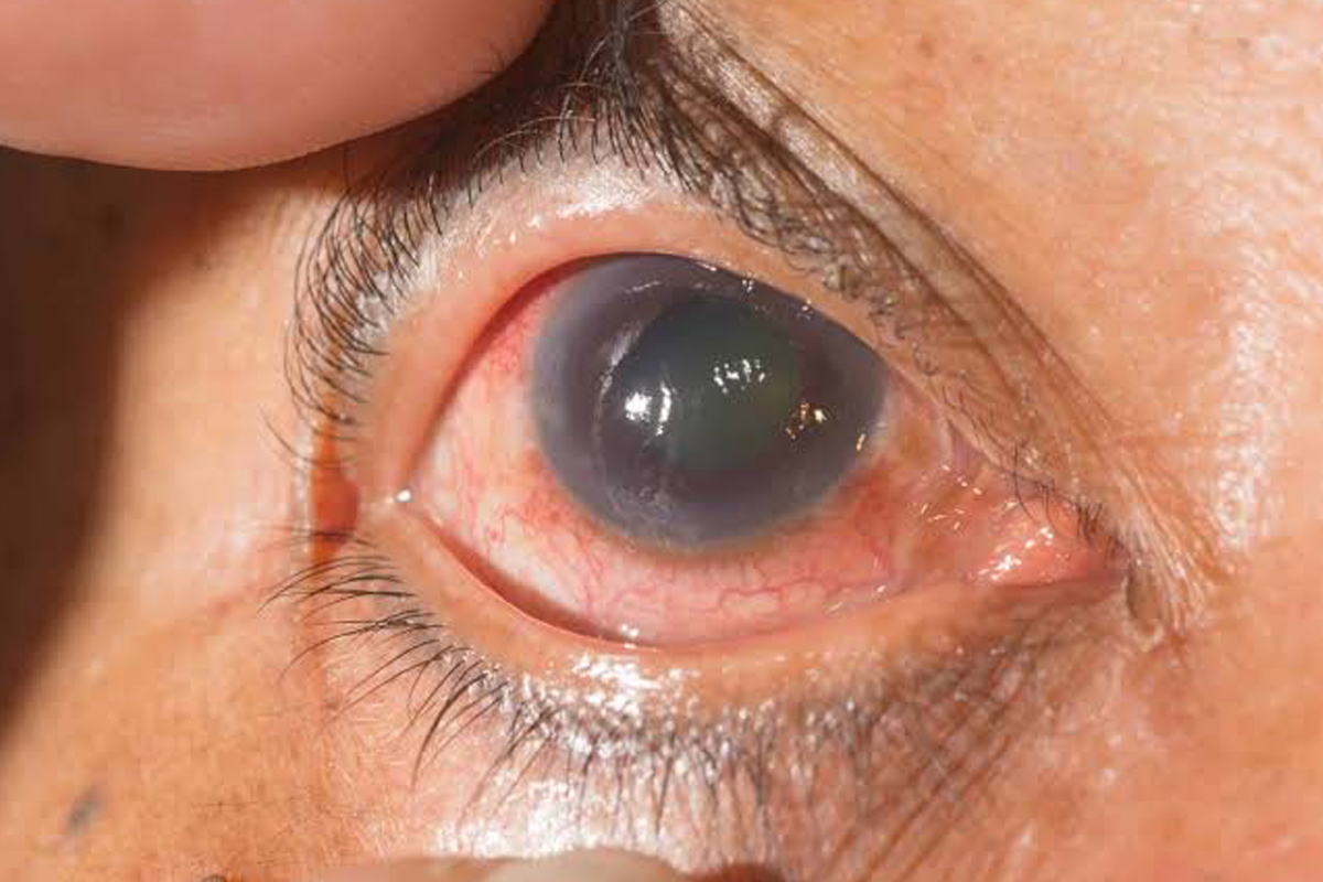 Glaucoma Disease in Andheri West